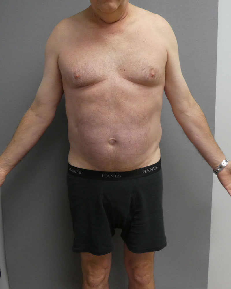 sculpsure-after-front-02