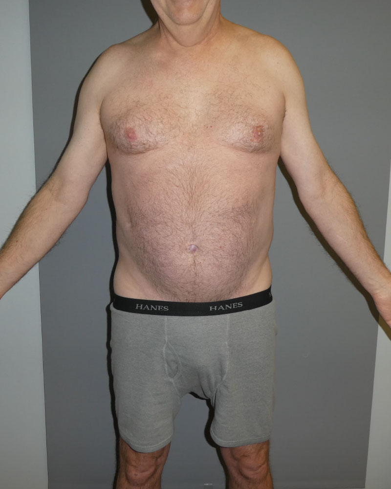sculpsure-before-front-02