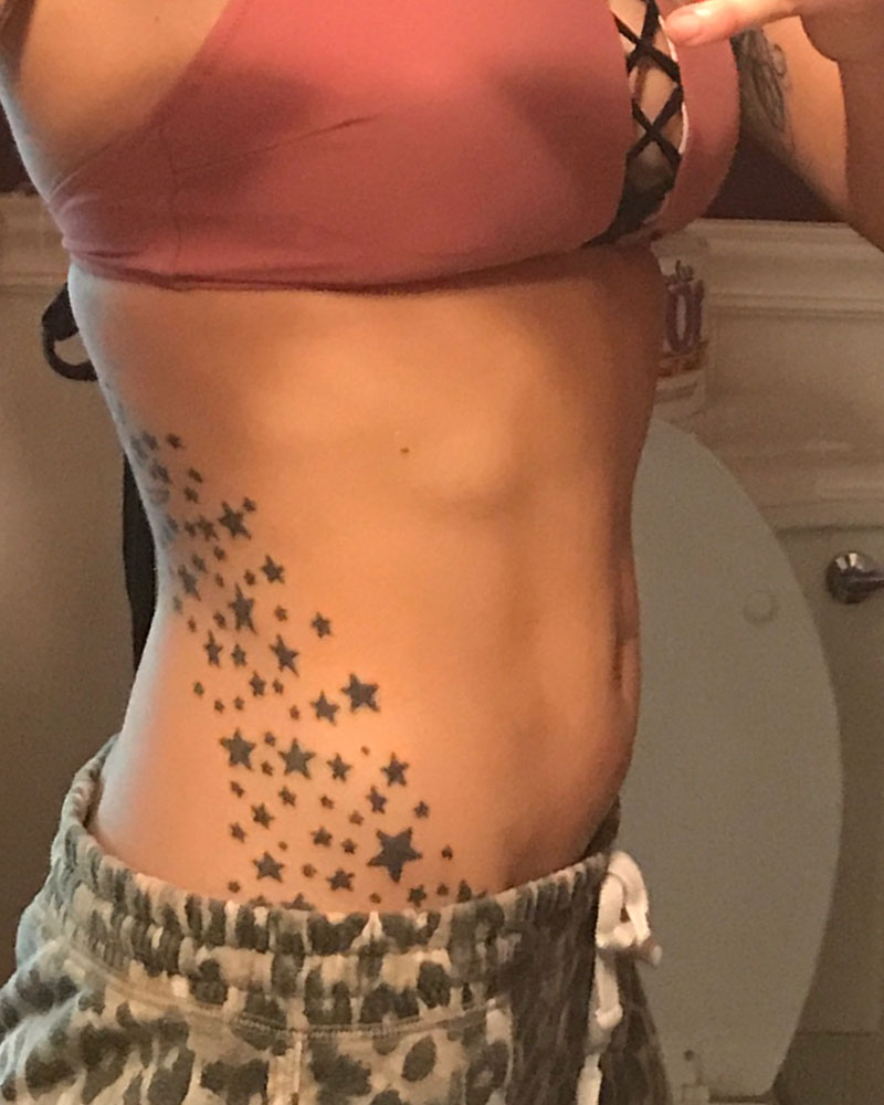 sculpsure-after-03