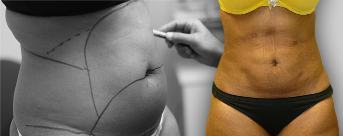 header-smart-lipo