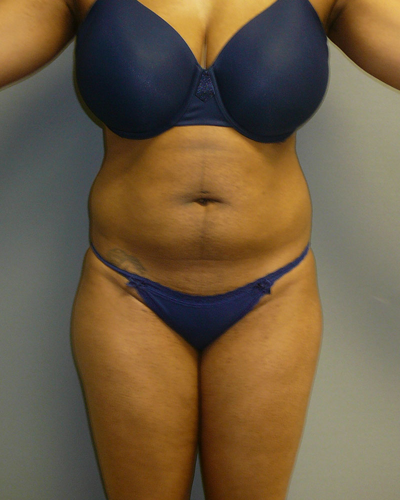 sculpsure-after-front-01