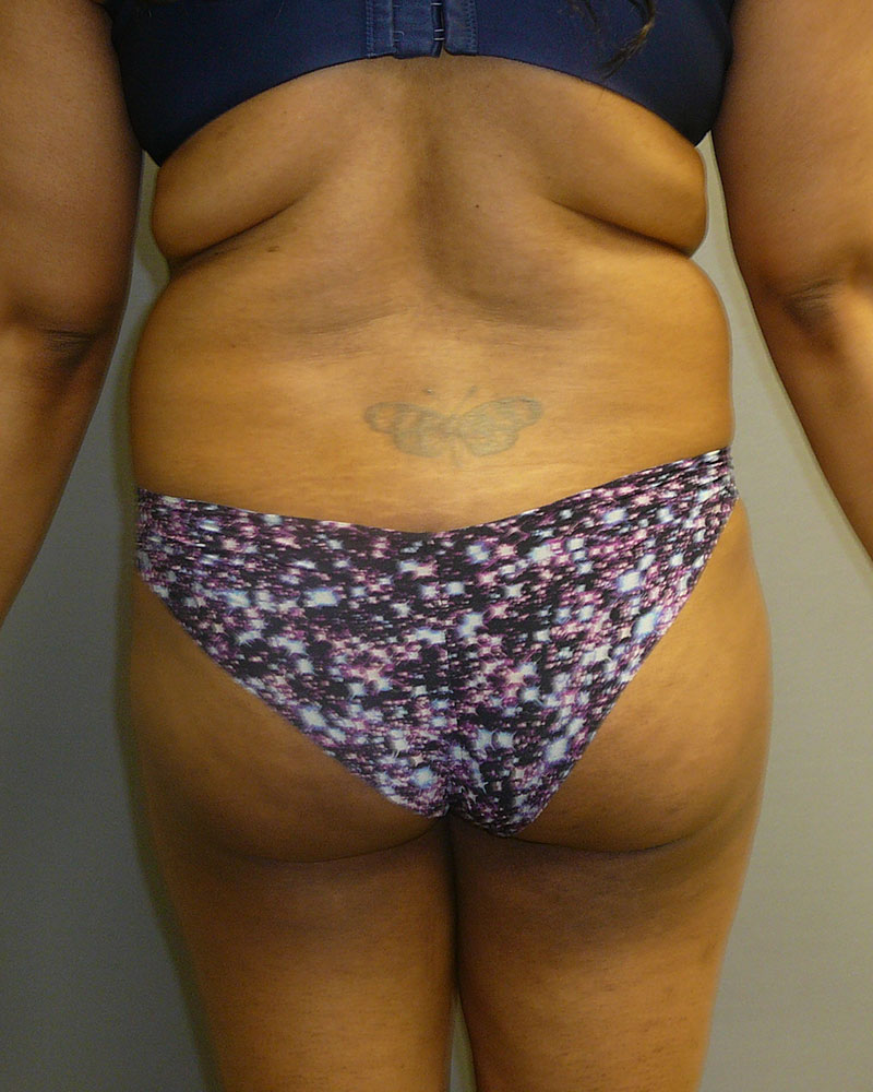 sculpsure-before-back-01
