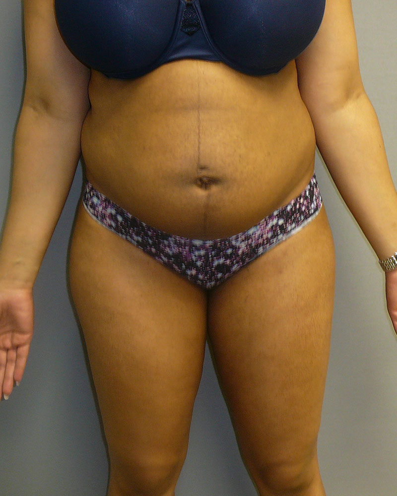 sculpsure-before-front-01